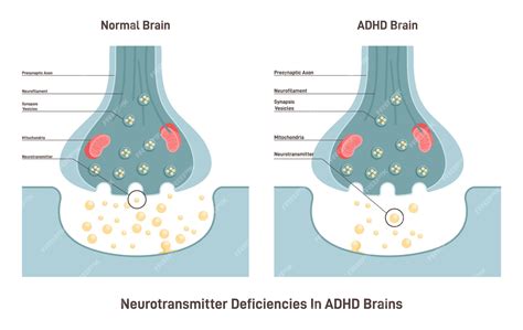 is adhd een beperking|ADHD (Attention Deficit Hyperactivity Disorder)